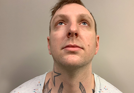 A Before Photo Of Septoplasty Surgery in Seattle, Burien, and Renton